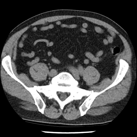 Aortic intramural hematoma (type B) (Radiopaedia 79323-92387 Axial non-contrast 90).jpg