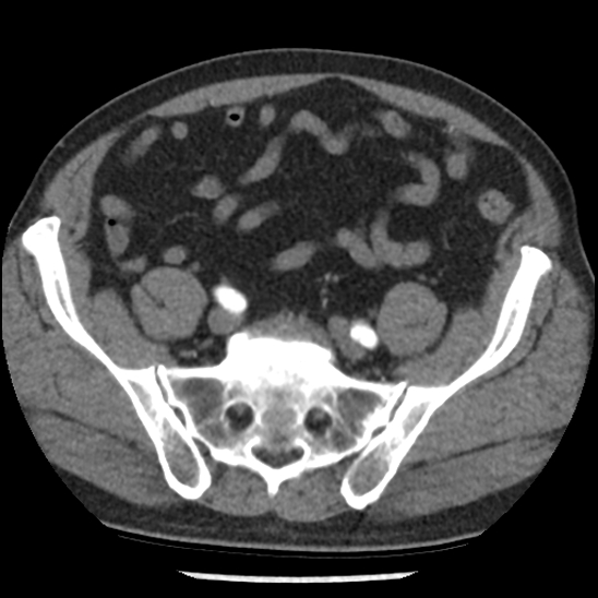 Aortic intramural hematoma (type B) (Radiopaedia 79323-92387 B 94).jpg