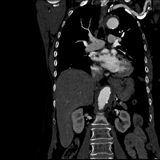 File:Aortic intramural hematoma from penetrating atherosclerotic ulcer (Radiopaedia 31137-31836 C 34).jpg
