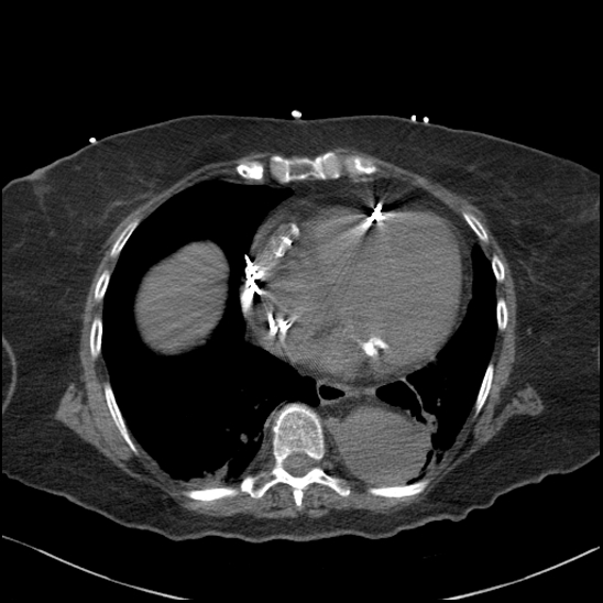 Aortic intramural hematoma with dissection and intramural blood pool (Radiopaedia 77373-89491 Axial non-contrast 66).jpg