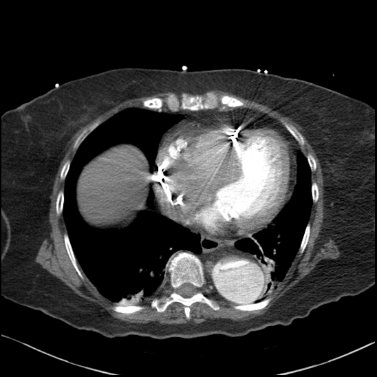 Aortic intramural hematoma with dissection and intramural blood pool (Radiopaedia 77373-89491 B 79).jpg