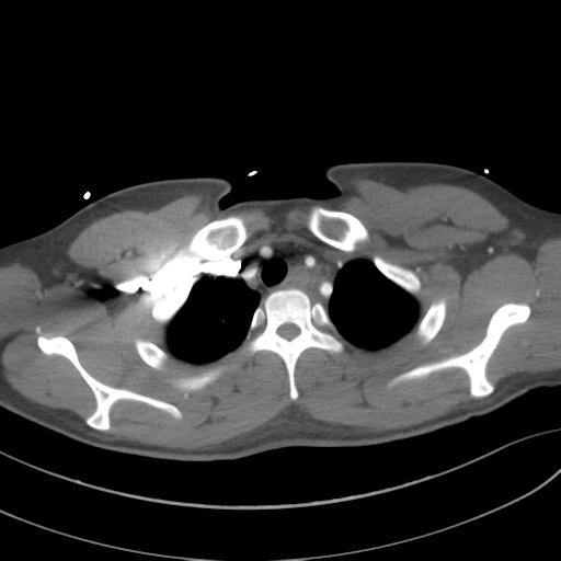 File:Aortic transection (Radiopaedia 29890-30405 A 19).jpg