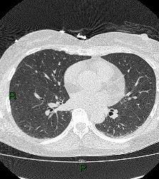 File:Aortic valve endocarditis (Radiopaedia 87209-103485 Axial lung window 58).jpg