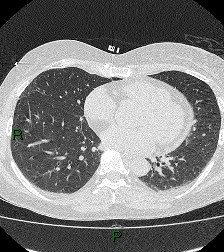 File:Aortic valve endocarditis (Radiopaedia 87209-103485 Axial lung window 63).jpg
