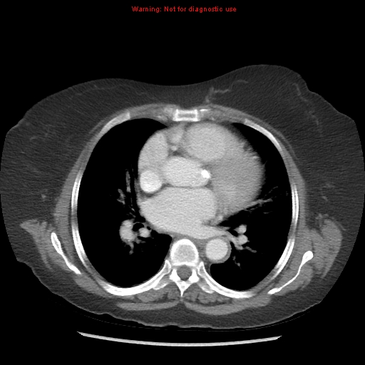 File:Aortic valve stenosis (Radiopaedia 14480-14423 C 4).jpg