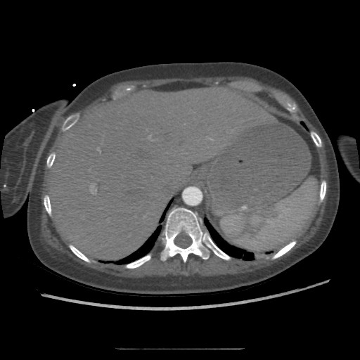Aorto-duodenal fistula (Radiopaedia 25668-25850 A 9).jpg