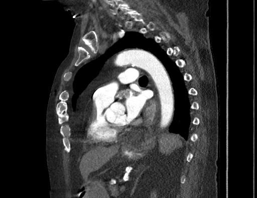 Aortoesophageal fistula with endovascular repair (Radiopaedia 73781-84592 Sagittal C+ CTPA 119).jpg