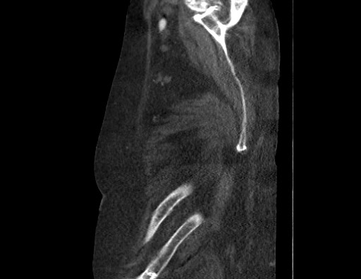 File:Aortoesophageal fistula with endovascular repair (Radiopaedia 73781-84592 Sagittal C+ CTPA 192).jpg