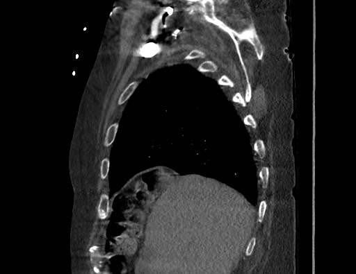 Aortoesophageal fistula with endovascular repair (Radiopaedia 73781-84592 Sagittal C+ CTPA 31).jpg