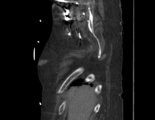 File:Aortoesophageal fistula with endovascular repair (Radiopaedia 73781-84592 Sagittal C+ CTPA 5).jpg