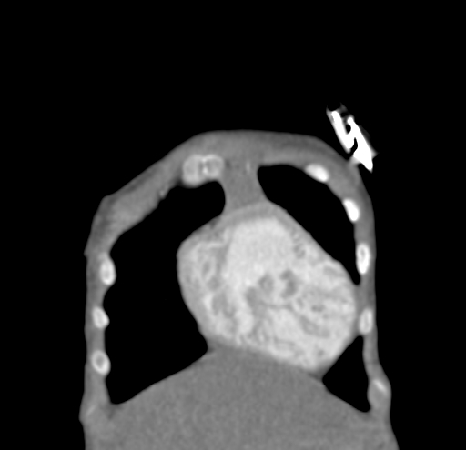 File:Aortopulmonary window, interrupted aortic arch and large PDA giving the descending aorta (Radiopaedia 35573-37074 D 4).jpg