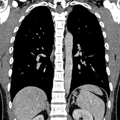 Apical lung mass mimic - neurogenic tumor (Radiopaedia 59918-67521 B 74).jpg