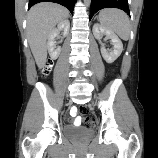 File:Appendicitis complicated by post-operative collection (Radiopaedia 35595-37113 B 35).jpg