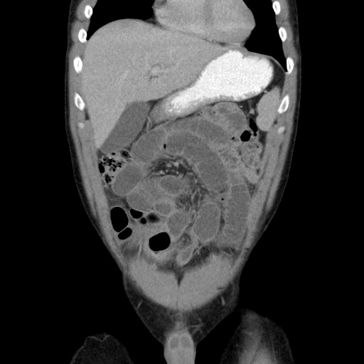 Appendicitis complicated by post-operative collection (Radiopaedia 35595-37114 B 17).jpg