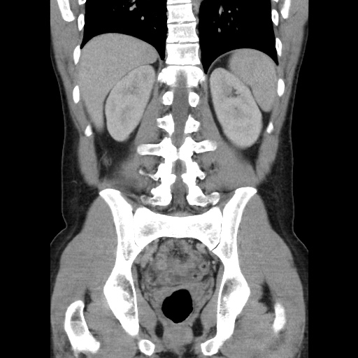 Appendicitis complicated by post-operative collection (Radiopaedia 35595-37114 B 39).jpg