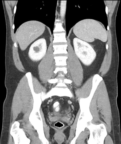 Appendicitis with cecal bar sign (Radiopaedia 31878-32830 A 42).jpg