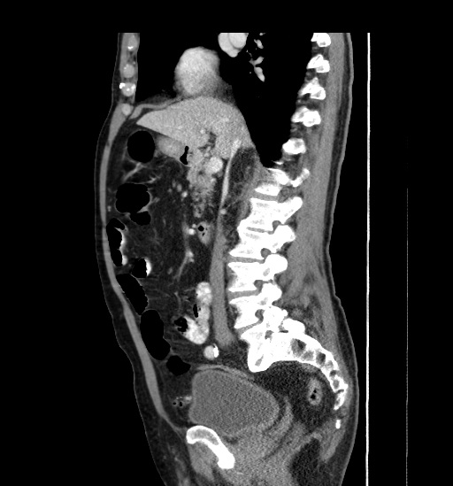 Appendicitis with localized perforation and abscess formation (Radiopaedia 49035-54130 C 28).jpg
