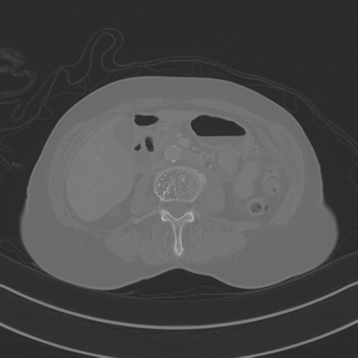 April fools' 2019- calcified peritoneal arachnoidosis (Radiopaedia 67273-76636 Axial bone window 18).png