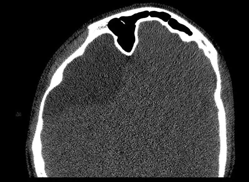 File:Arachnoid cyst- extremely large (Radiopaedia 68741-78450 Axial bone window 45).jpg