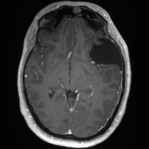 File:Arachnoid cyst with subdural hematoma (Radiopaedia 85892-101743 Axial T1 C+ 41).png
