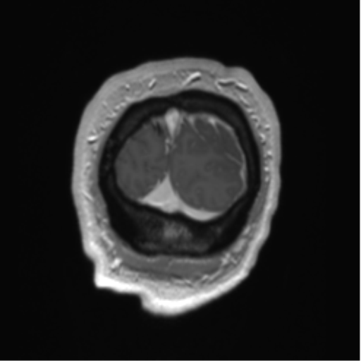 File:Arachnoid cyst with subdural hematoma (Radiopaedia 85892-101743 Coronal T1 C+ 5).png