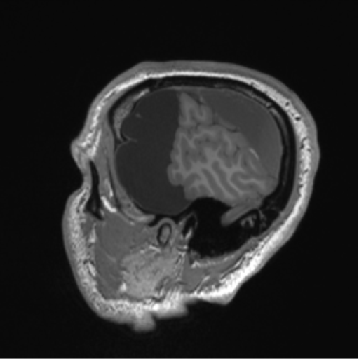 Arachnoid cyst with subdural hematoma (Radiopaedia 85892-101743 Sagittal T1 17).png
