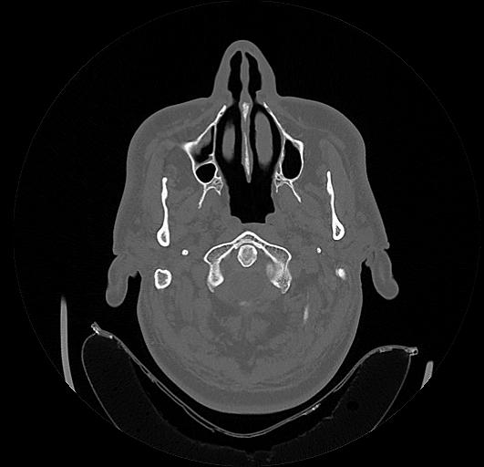 Arcuate foramen (Radiopaedia 89833-106944 Axial bone window 16).jpg