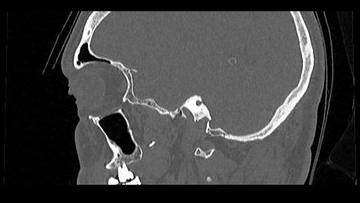 Arcuate foramen (Radiopaedia 89833-106944 Sagittal bone window 114).jpg