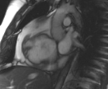 File:Arrhythmogenic right ventricular cardiomyopathy (Radiopaedia 69431-79307 Short axis cine 222).jpg