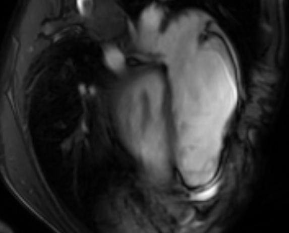 Arrhythmogenic right ventricular cardiomyopathy (Radiopaedia 69564-79464 4ch cine 119).jpg