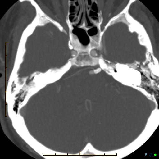 File:Artifactual basilar artery stenosis due to metallic stent (Radiopaedia 31206-31923 A 12).jpg
