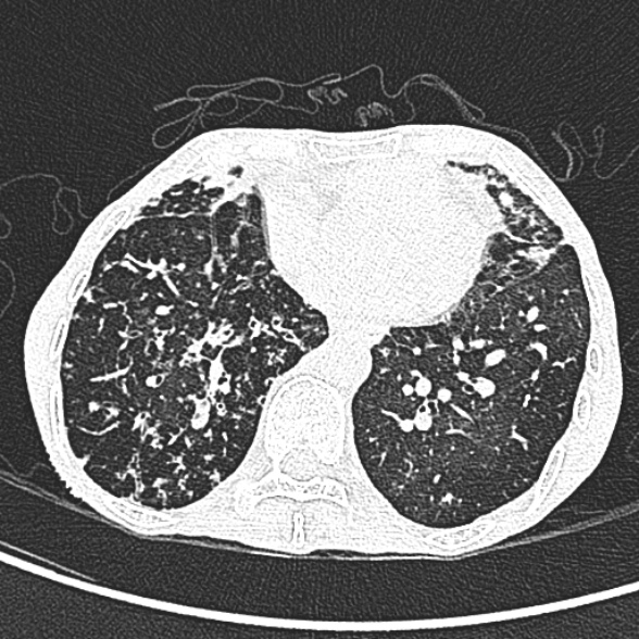 Aspergilloma- with Monod sign (Radiopaedia 44737-48532 Axial lung window 188).jpg