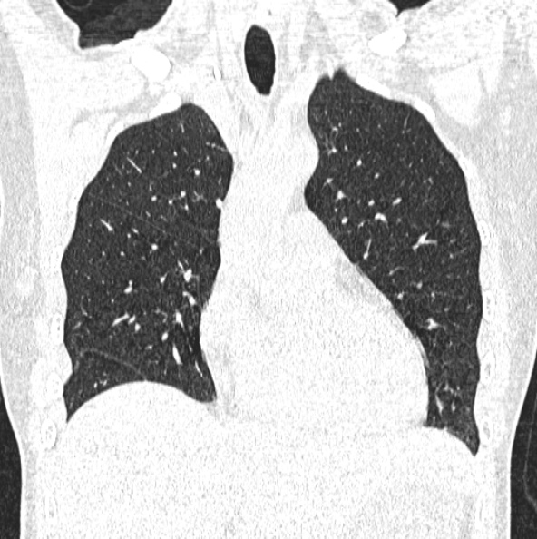 File:Aspergilloma (Radiopaedia 26223-26347 Coronal lung window 17).jpg