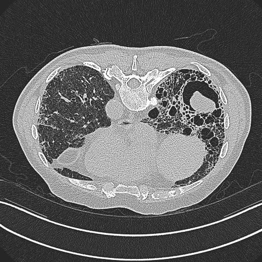 File:Aspergilloma on background pulmonary fibrosis (Radiopaedia 60942-68757 Axial lung window 19).jpg