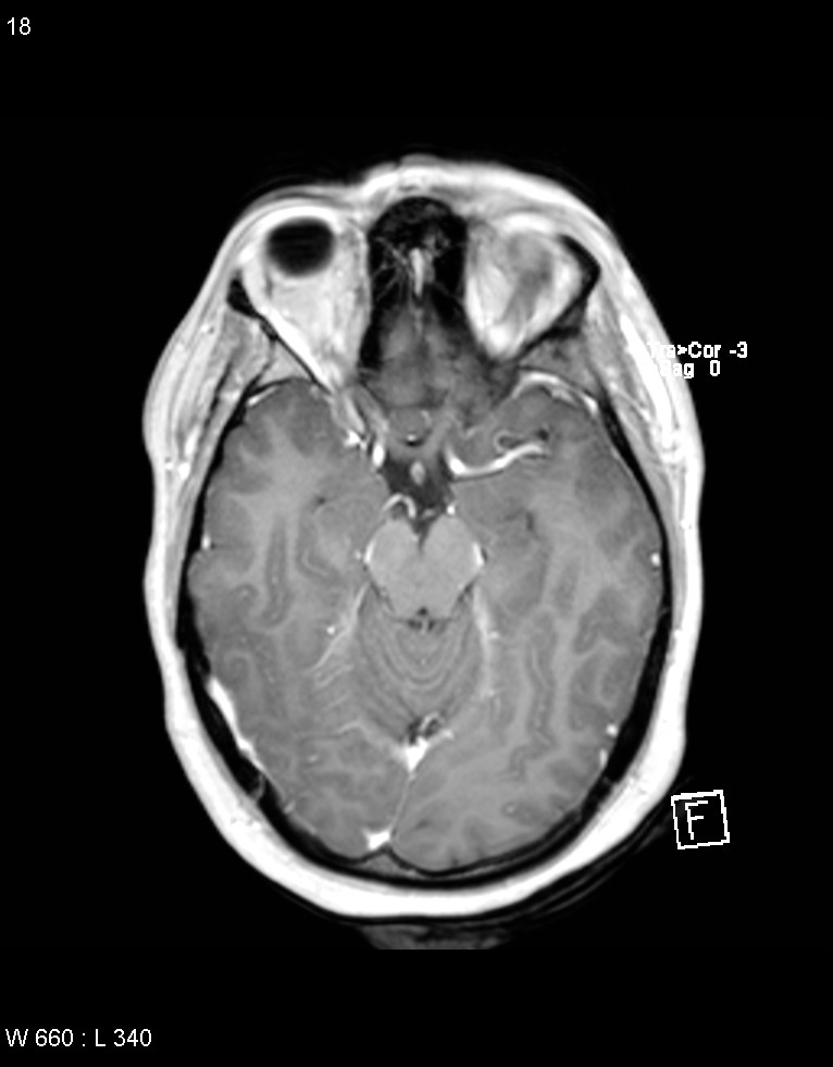 Astroblastoma (Radiopaedia 39792-42218 Axial T1 C+ 17).jpg