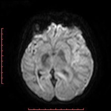 Astroblastoma (Radiopaedia 74287-85162 Axial DWI 49).jpg