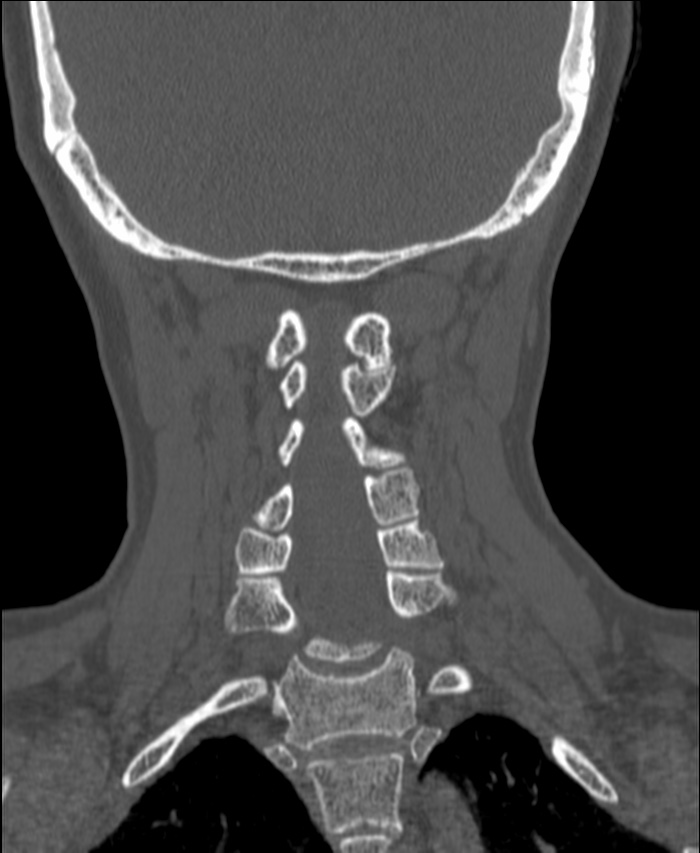 Atlanto-occipital assimilation with basilar invagination (Radiopaedia 70122-80188 Coronal bone window 151).jpg