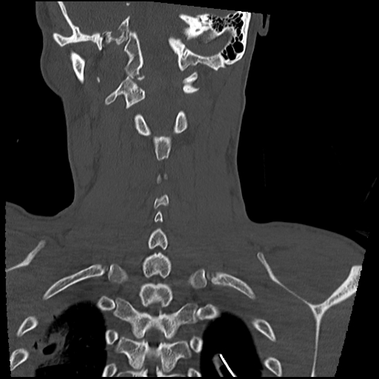 Atlanto-occipital dissociation (Traynelis type 1), C2 teardrop fracture, C6-7 facet joint dislocation (Radiopaedia 87655-104061 Coronal bone window 49).jpg