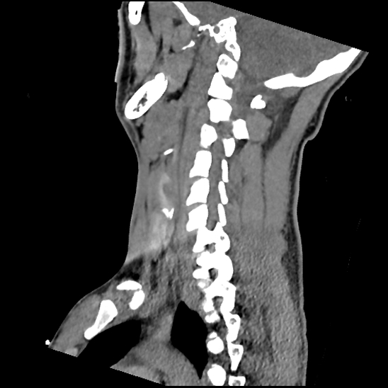 File:Atlanto-occipital dissociation (Traynelis type 1), C2 teardrop fracture, C6-7 facet joint dislocation (Radiopaedia 87655-104061 D 53).jpg