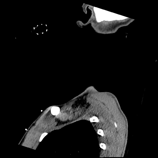 File:Atlanto-occipital dissociation (Traynelis type 1), C2 teardrop fracture, C6-7 facet joint dislocation (Radiopaedia 87655-104061 D 79).jpg