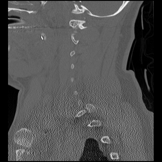 File:Atlanto-occipital dissociation injury (Radiopaedia 29274-29698 Sagittal bone window 16).png