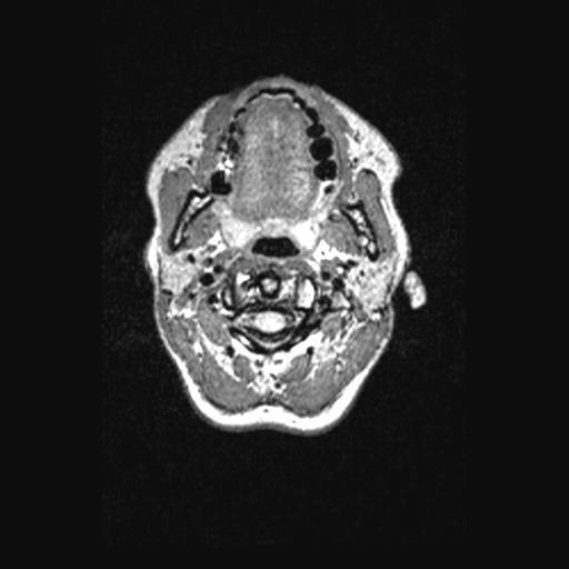 Atretic encephalocoele with inferior vermis hypoplasia (Radiopaedia 30443-31108 Axial 6).jpg