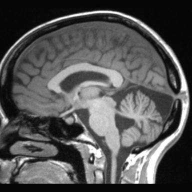 Atretic encephalocoele with inferior vermis hypoplasia (Radiopaedia 30443-31108 Sagittal T1 63).jpg