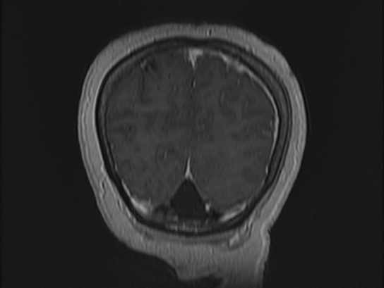Atypical meningioma (Radiopaedia 62985-71406 Coronal T1 C+ 113).jpg