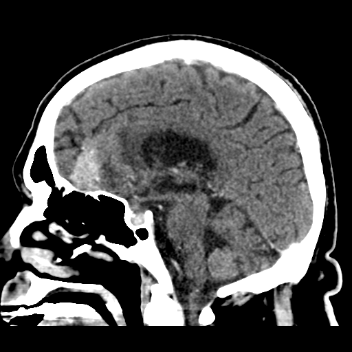 Atypical meningioma (WHO grade II) with brain invasion (Radiopaedia 57767-64728 Sagittal C+ 28).png