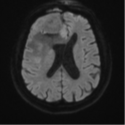 Atypical meningioma (WHO grade II) with brain invasion (Radiopaedia 57767-64729 Axial DWI 48).png