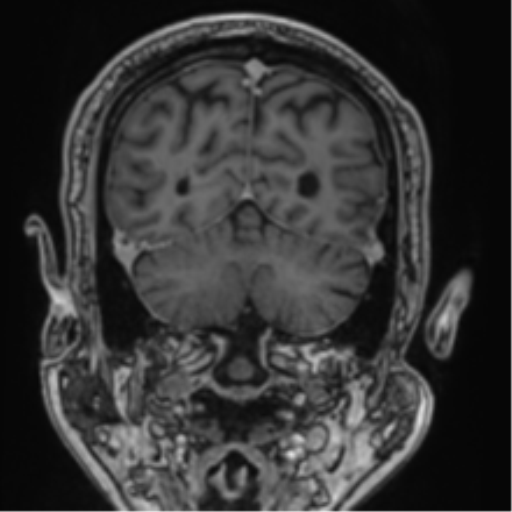 File:Atypical meningioma (WHO grade II) with brain invasion (Radiopaedia 57767-64729 Coronal T1 C+ 65).png