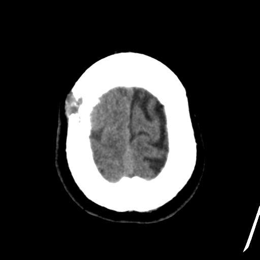Atypical meningioma (WHO grade II) with osseous invasion (Radiopaedia 53654-59715 Axial non-contrast 47).png