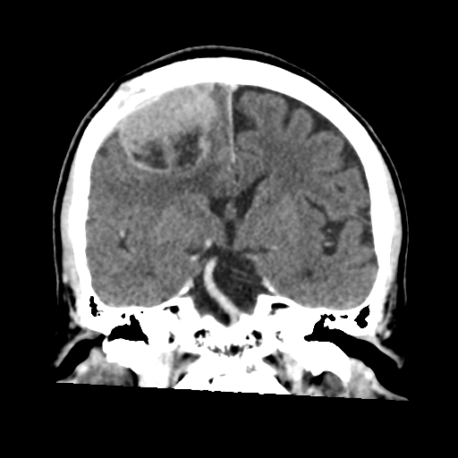 Atypical meningioma (WHO grade II) with osseous invasion (Radiopaedia 53654-59715 Coronal C+ delayed 30).png