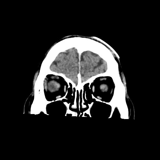Atypical meningioma with skull invasion (Radiopaedia 34357-35649 Coronal C+ delayed 11).png
